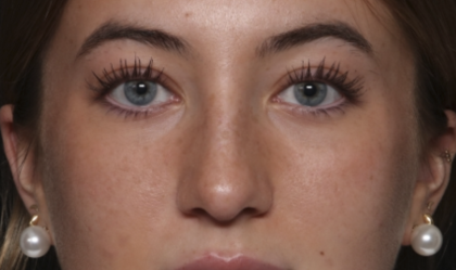 Rhinoplasty Before & After Patient #36397