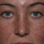 Rhinoplasty Before & After Patient #36397