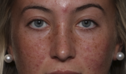 Rhinoplasty Before & After Patient #36397