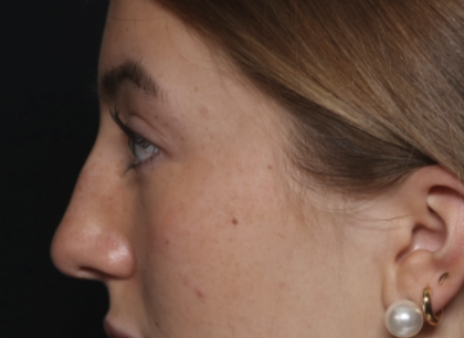 Rhinoplasty Before & After Patient #36397