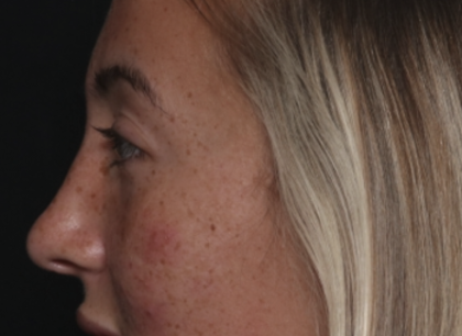 Rhinoplasty Before & After Patient #36397