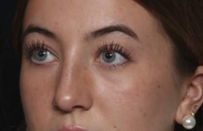 Rhinoplasty Before & After Patient #36397