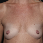 Breast Augmentation Before & After Patient #36451