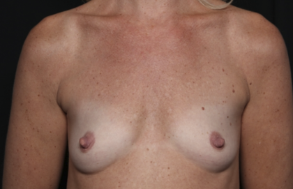 Breast Augmentation Before & After Patient #36451