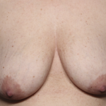 Breast Lift Before & After Patient #36574