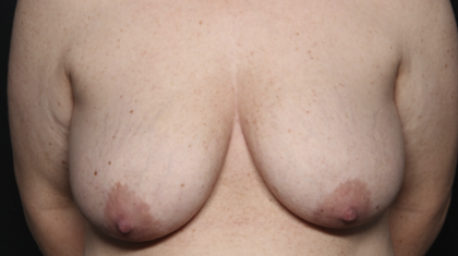 Breast Lift Before & After Patient #36574
