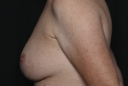 Breast Lift Before & After Patient #36574