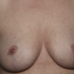 Breast Lift Before & After Patient #36574