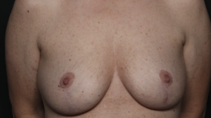 Breast Lift Before & After Patient #36574