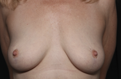 Breast Lift Before & After Patient #36598