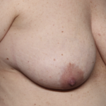 Breast Lift Before & After Patient #36574