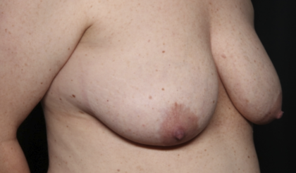 Breast Lift Before & After Patient #36574