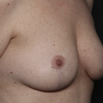 Breast Lift Before & After Patient #36574