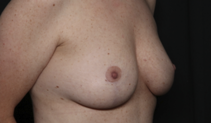 Breast Lift Before & After Patient #36574