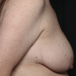 Breast Lift Before & After Patient #36574