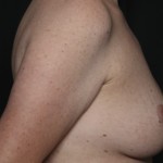 Breast Lift Before & After Patient #36574