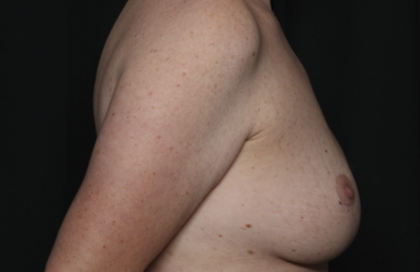 Breast Lift Before & After Patient #36574