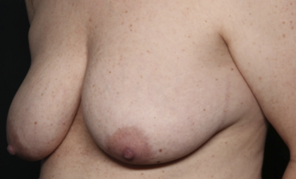 Breast Lift Before & After Patient #36574