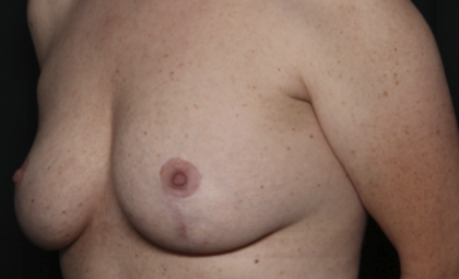 Breast Lift Before & After Patient #36574
