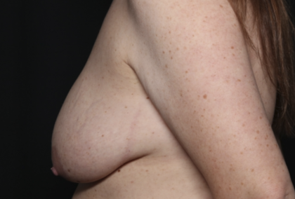 Breast Lift Before & After Patient #36574