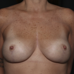 Breast Lift Before & After Patient #36490