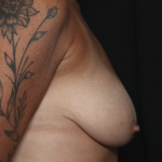 Breast Lift Before & After Patient #36490