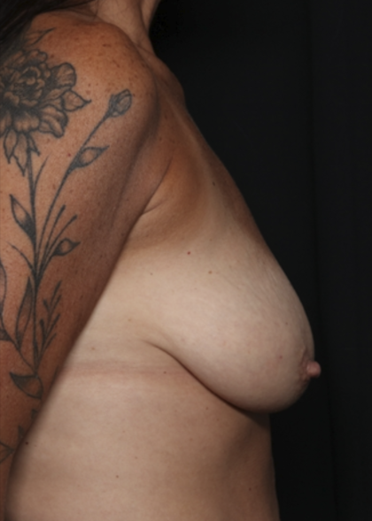Breast Lift Before & After Patient #36490