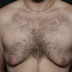 Gynecomastia Before & After Patient #36487