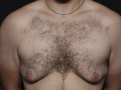 Gynecomastia Before & After Patient #36487