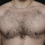 Gynecomastia Before & After Patient #36487