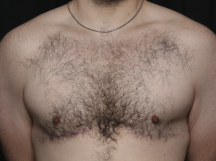Gynecomastia Before & After Patient #36487