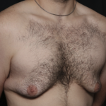 Gynecomastia Before & After Patient #36487