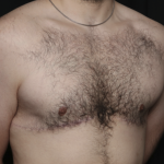 Gynecomastia Before & After Patient #36487
