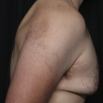 Gynecomastia Before & After Patient #36487