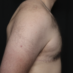 Gynecomastia Before & After Patient #36487