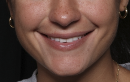 Lip Filler Before & After Patient #36569