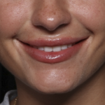 Lip Filler Before & After Patient #36569