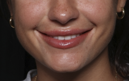 Lip Filler Before & After Patient #36569