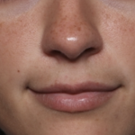 Lip Filler Before & After Patient #36569