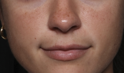 Lip Filler Before & After Patient #36569