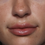 Lip Filler Before & After Patient #36569
