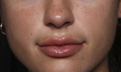 Lip Filler Before & After Patient #36569