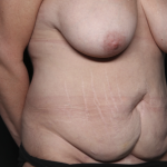 Mommy Makeover Before & After Patient #36440