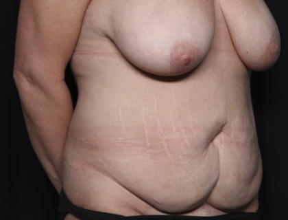 Mommy Makeover Before & After Patient #36440