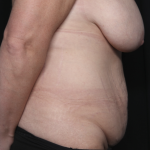 Mommy Makeover Before & After Patient #36440