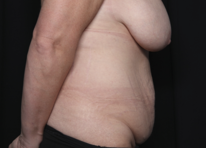 Mommy Makeover Before & After Patient #36440