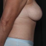 Mommy Makeover Before & After Patient #36440