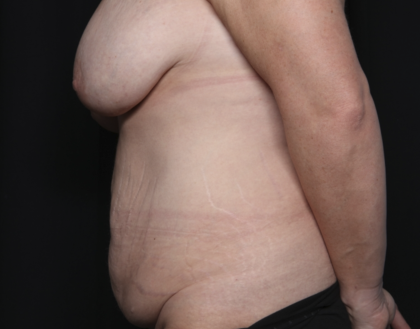 Mommy Makeover Before & After Patient #36440