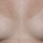 Nipple Revision Before & After Patient #36464