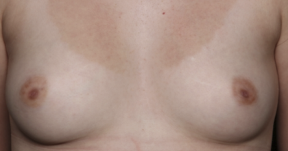 Nipple Revision Before & After Patient #36464